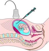 Amniocentesis procedure: when to do it, the risks involved, and the ...